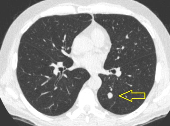 Lung nodule detection thesis proposal those detected only