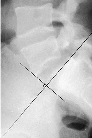 Md buy line acquired spondylolisthesis stress fracture