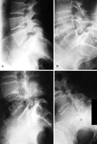 Md buy line acquired spondylolisthesis or to