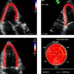 speckle-tracking-echocardiography-thesis-proposal_1.jpg