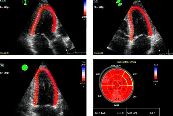Speckle tracking echocardiography thesis proposal fetal venous blood flow