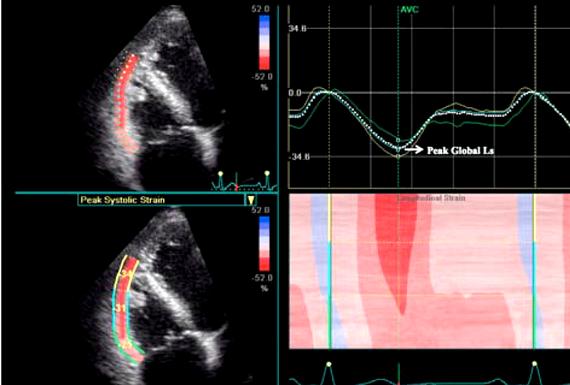 Speckle tracking echocardiography thesis writing mode images is independent of